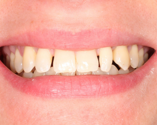 Rebecca Before Braces
