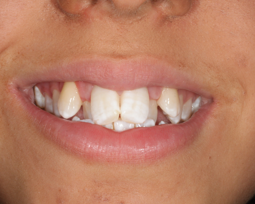 Jessica before braces