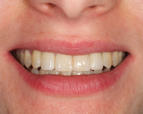 Rebecca After Braces