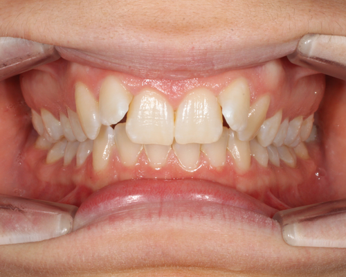 Bethany BEFORE Invisalign Treatment