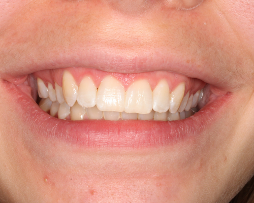 Bethany AFTER Invisalign Treatment