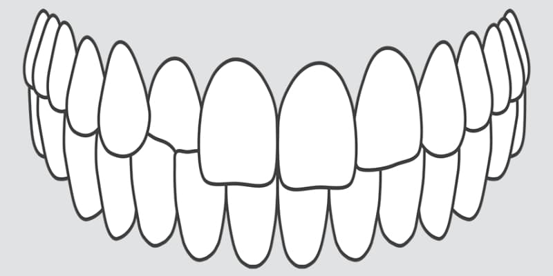 Crossbite