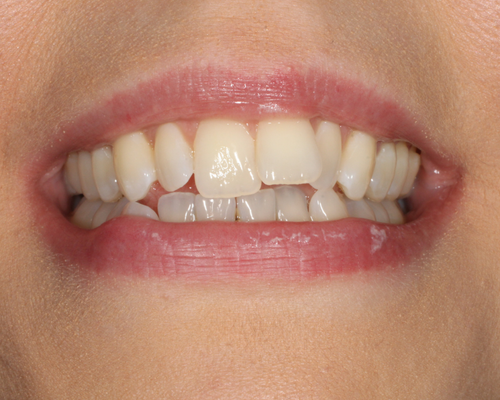 Elaine BEFORE Invisalign Treatment