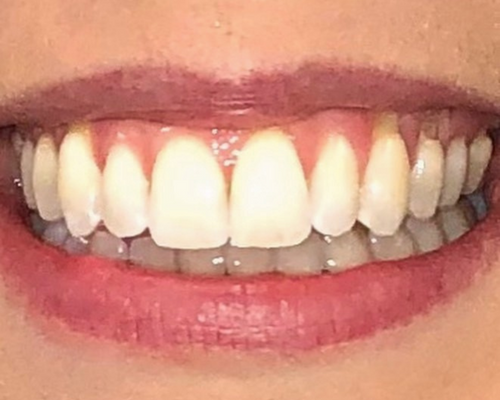 Elaine After treatment