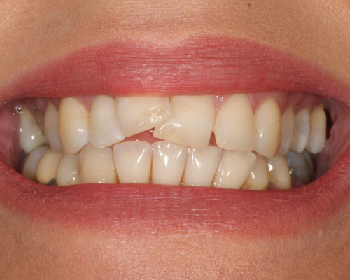Emma Before Invisalign
