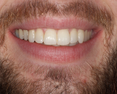 Matt AFTER Damon Clear Fixed Braces