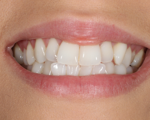 Sophia BEFORE Damon Clear Braces