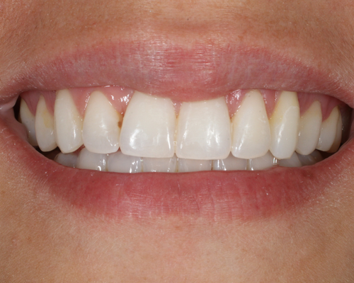 Sophia AFTER Damon Clear Braces
