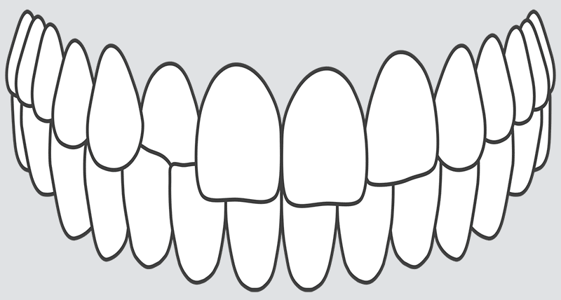 crooked teeth cross bite