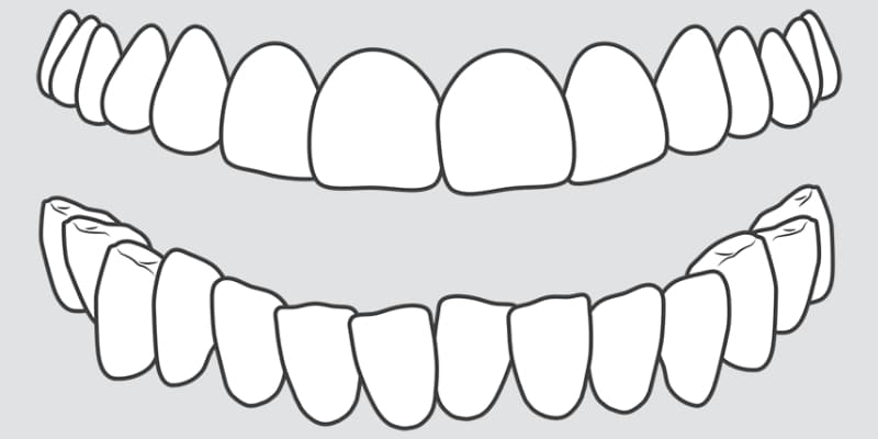 crooked teeth crowding