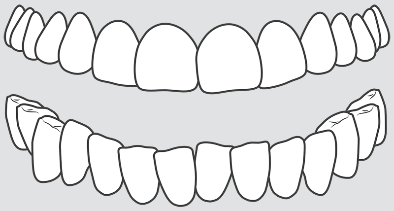 Crooked teeth crowding