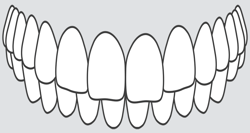 crooked teeth over bite