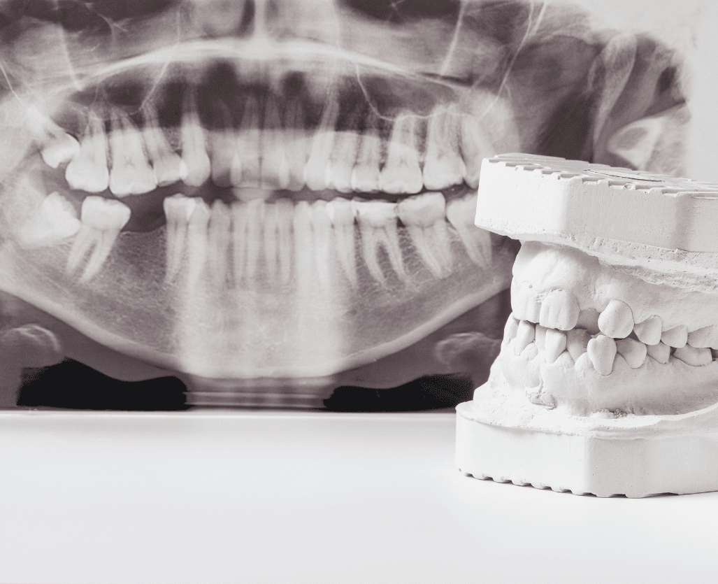 Crooked teeth and distal bite