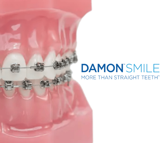 Damon Braces