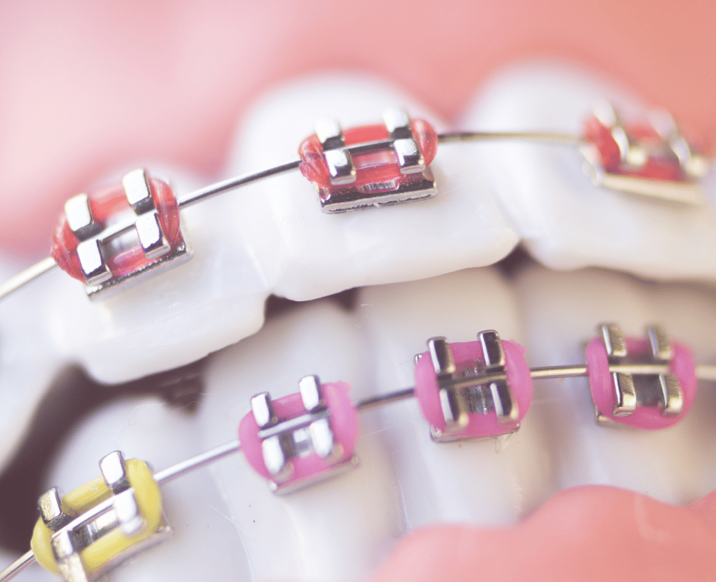 dental metal wire teeth brackets