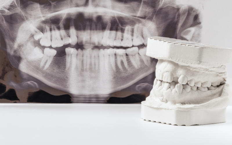 Dental X-Ray of teeth