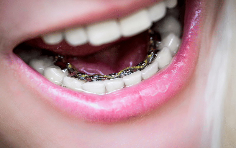 Lingual Braces